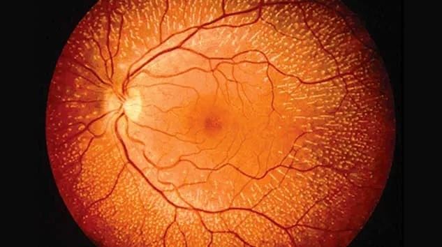 retina