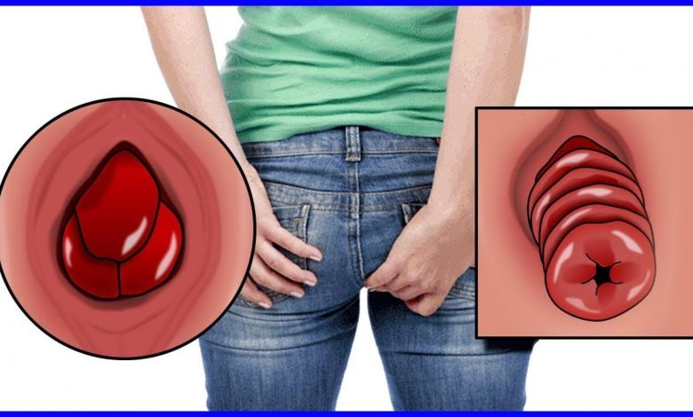 Best treatment for Piles
