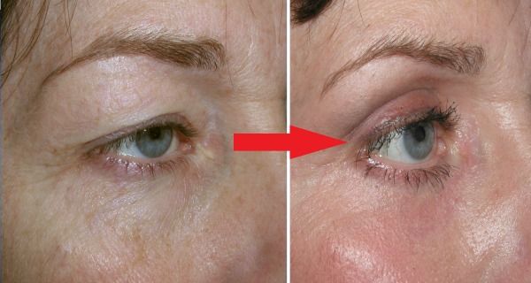 4 Natural Remedies For Loose Eyelid Lifts