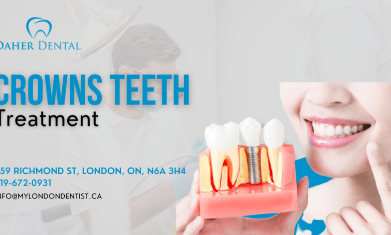 dental crowns teeth