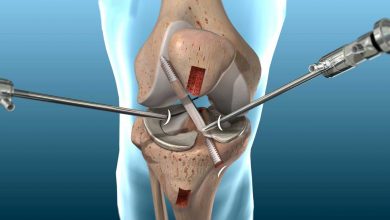 Photo of All about knee revision surgery and treatment