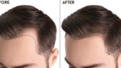 Photo of Having Hair Loss Issues? Hair Transplant is All You Need
