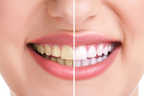 Teeth Whitening at Home