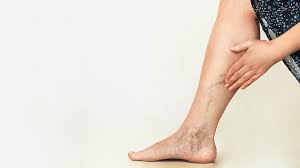 Photo of Which are Different Types of Vein Treatments?